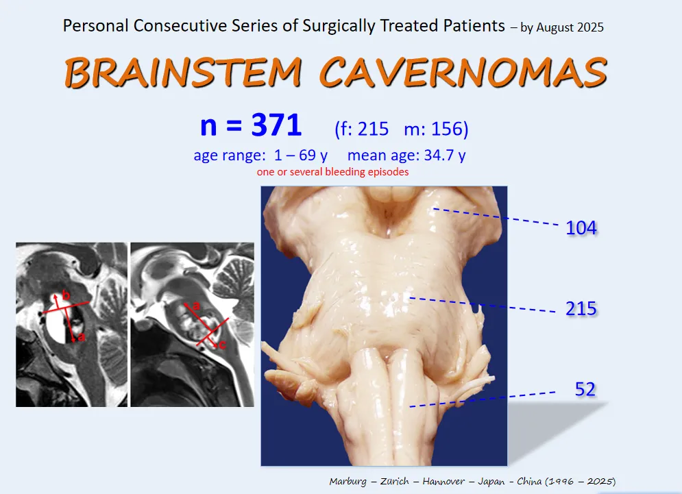 巴教授强调,手术入路的选择至关重要。