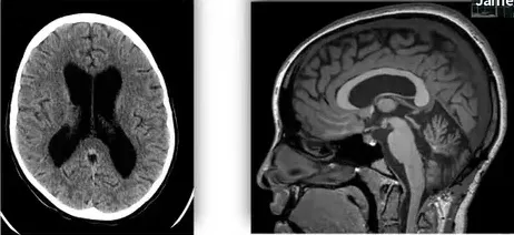 一开始是眼球转动受限(核间眼肌麻痹),后面快速发展成了严重的共济失调和右侧肢体无力,甚至无法直立行走,随后又出现吞咽障碍和左侧面瘫,直到她生活不能自理。