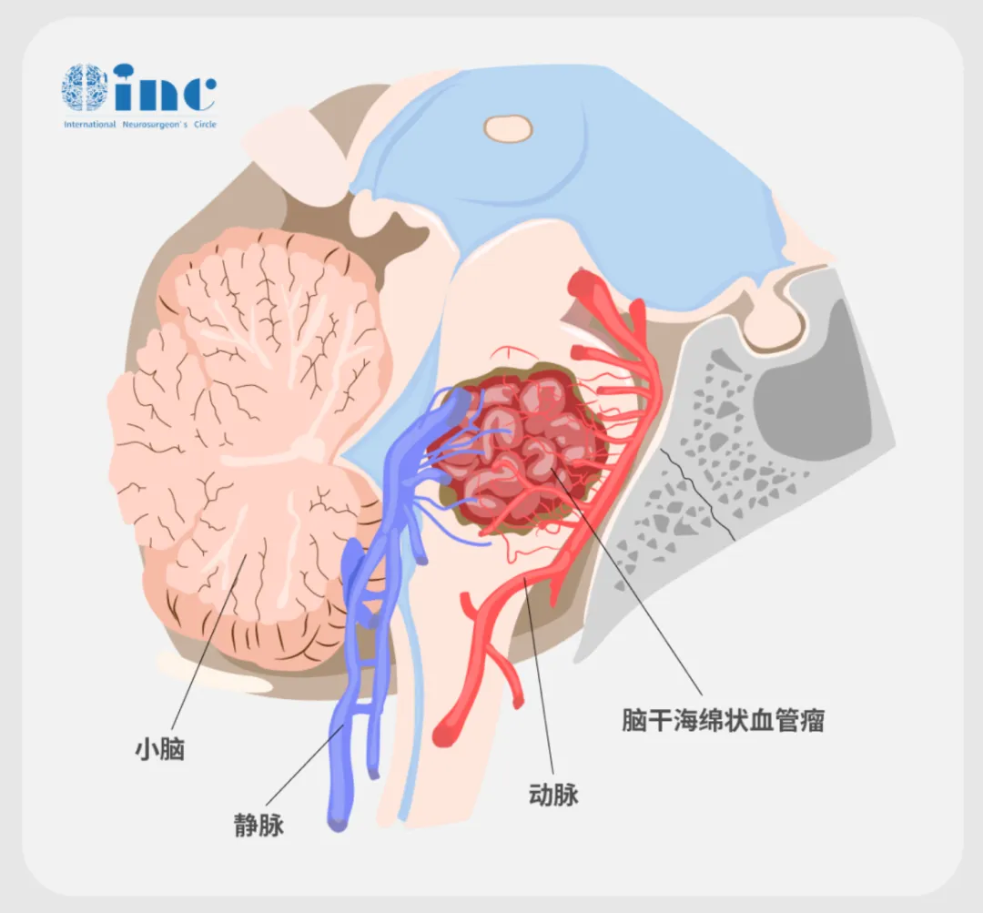 脑海绵状血管瘤（CCM）并非真正的肿瘤，而是一种血管畸形。