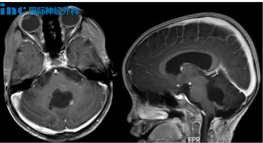 2次室管膜瘤切除术后复发  还有手术机会吗？