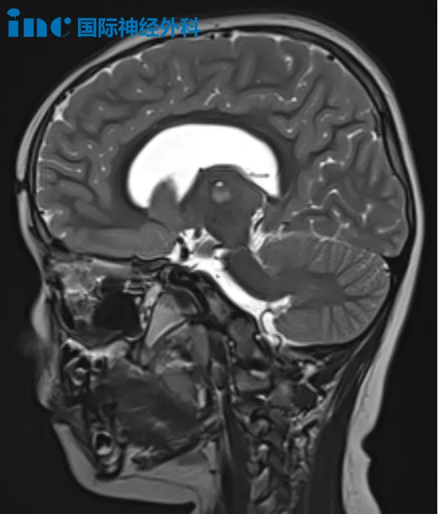 头晕呕吐发现<a href='/naoliu/' target='_blank'><u>脑瘤</u></a>  第三脑室底造瘘术+病损切除术后