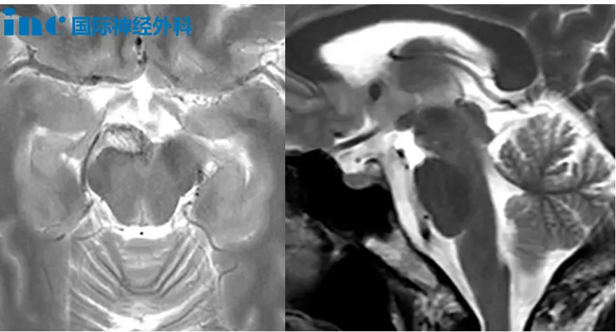右侧桥前池占位少量出血 为何巴教授不建议立即手术？