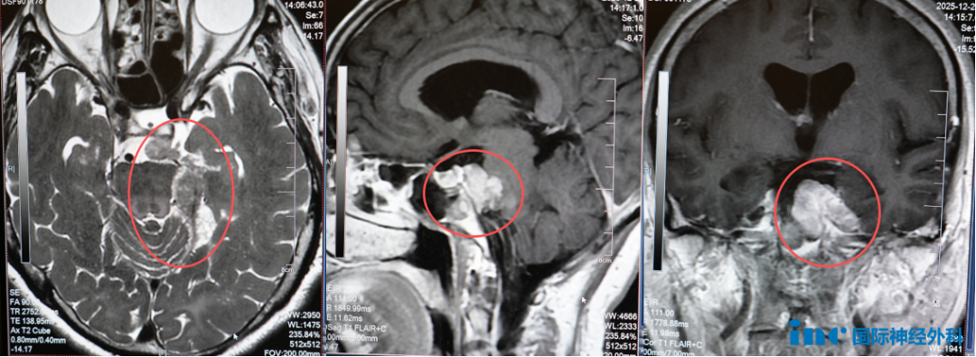 61岁鲁女士左侧桥小脑角区占位
