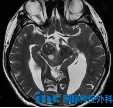 22岁小翼神经纤维瘤病Ⅰ型