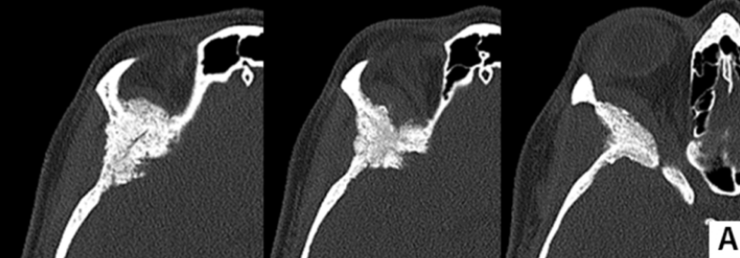 术前计算机断层扫描图像（骨窗）显示由蝶眶脑膜瘤引起的增生，涉及蝶骨大翼、蝶骨小翼、前床突以及眼眶上壁以及颞骨鳞部。