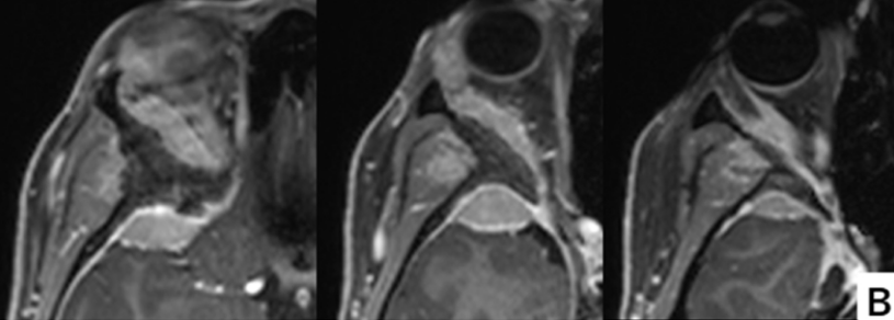 术前增强MRI显示蝶眶脑膜瘤从眶上壁延伸至外侧眶壁以及眶周。颞极硬膜和颞肌也被浸润。眼眶受压导致眼球突出。