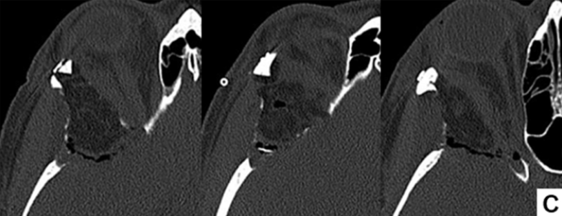 术后CT显示脑膜瘤和反应性增生的骨质均被完全切除。