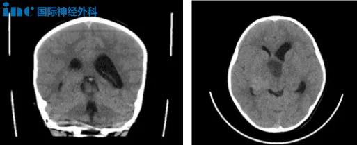 确诊了视神经-下丘脑胶质瘤,肿瘤累及视神经、视交叉、视束、视放射、丘脑底垂体轴、第三脑室、脑底动脉环等重要结构,已出现视力下降、头痛、呕吐等症状。