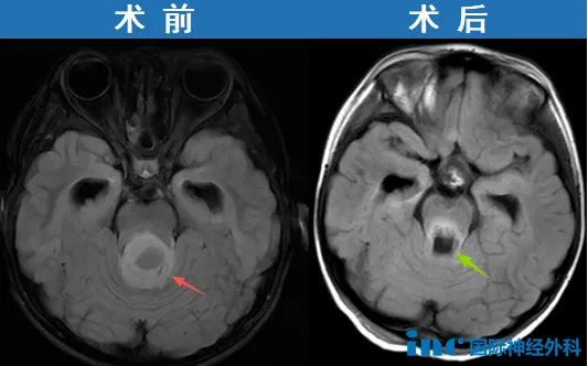手术结果理想,医生在内镜下全切肿瘤