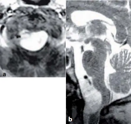 颅颈交界区脑膜瘤背外侧入路操作技巧详解