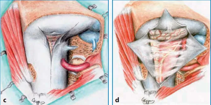 图13.13 a，b术前MR图像（T1-W增强扫描，b矢状T2-W）显示一个大的枕大孔脑膜瘤，该脑膜瘤向背侧生长，严重压迫颈髓。c、图示硬脑膜切开，肿瘤的背外侧和腹侧部分暴露，通过侧面反射硬脑膜和椎动脉的远端V3部分。