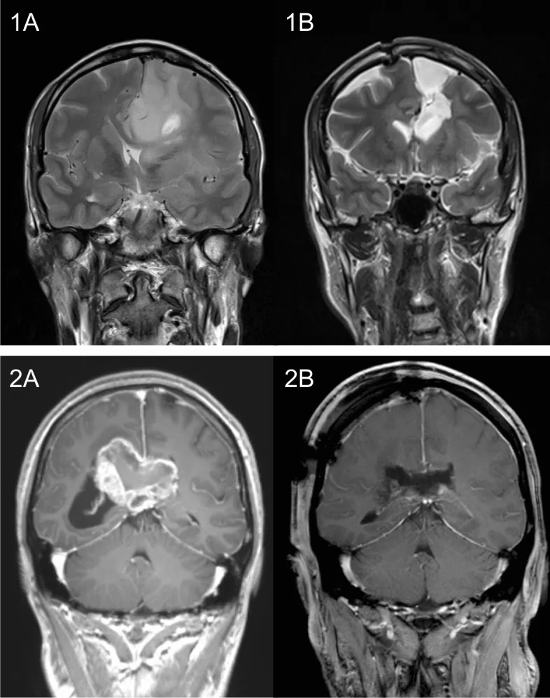 两例胼胝体侵犯性胶质母细胞瘤患者示例。图(1A)与(2A)显示术前肿瘤情况,图(1B)与(2B)显示术后结果。患者1,36岁,接受了巨大左额叶胶质母细胞瘤的次全切除术,后续行同步放化疗。该患者在任一观察时间点(即术前及长期随访期间)均未出现任何严重认知功能障碍。患者2,38岁,接受了侵犯胼胝体压部主体的巨大胶质母细胞瘤次全切除术。术前该患者存在严重记忆障碍,术后逐渐改善;术后新出现的轻度注意力及语言功能障碍亦随恢复逐步好转。