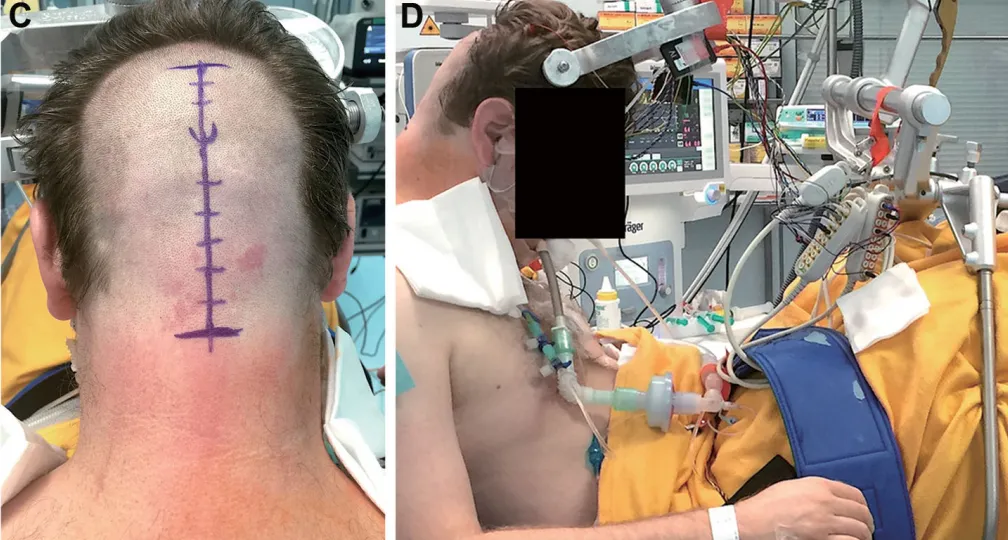 医生在他的枕部/枕下中线处标记了切口。这个切口位置允许医生沿着小脑幕边缘进入,直接抵达中脑背侧。