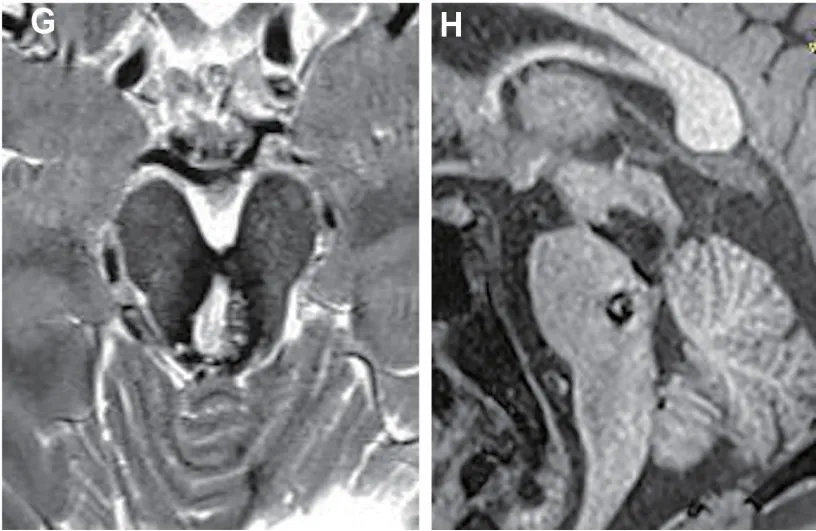 术后5个月轴位、矢状位磁共振成像,证实中脑海绵状畸形(MCM)完全切除。
