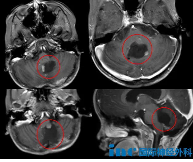 MRI增强扫描中仅显示为3处强化灶,但实际开颅后,发现存在更多未显影的肿瘤