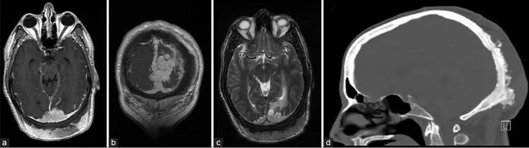 图1.轴位（a）与冠状位（b）增强T1加权MRI显示肿瘤包绕上矢状窦后部并延伸至窦汇。可见枕部头皮异常增厚。（c）轴位T2加权MRI序列显示枕叶白质异常高信号，符合肿瘤实质侵犯所致血管源性水肿。（d）增强CT扫描骨窗位矢状面图像显示肿瘤浸润导致枕骨同时存在骨质增生和增厚