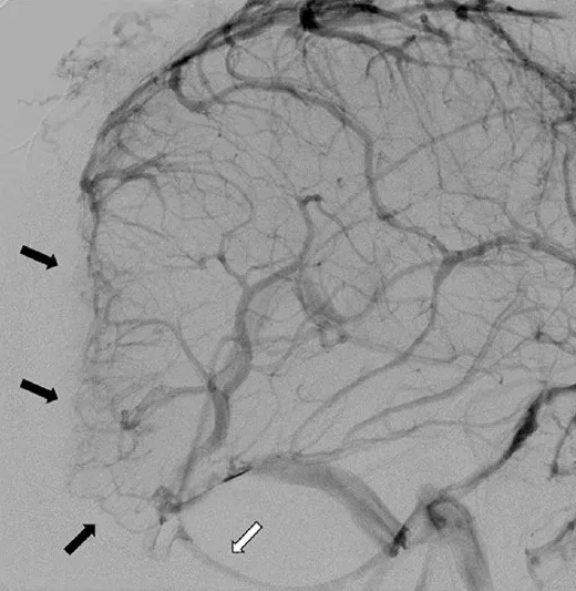图2.左侧颈内动脉注射后脑血管造影侧位观。后颅窝/轴外肿瘤侵犯并闭塞了7cm长的上矢状窦后部、窦汇及横窦近端（黑色箭头）。横窦远端可见血流重建。深部静脉经连接直窦与左侧颈静脉球的枕窦引流（白色箭头）