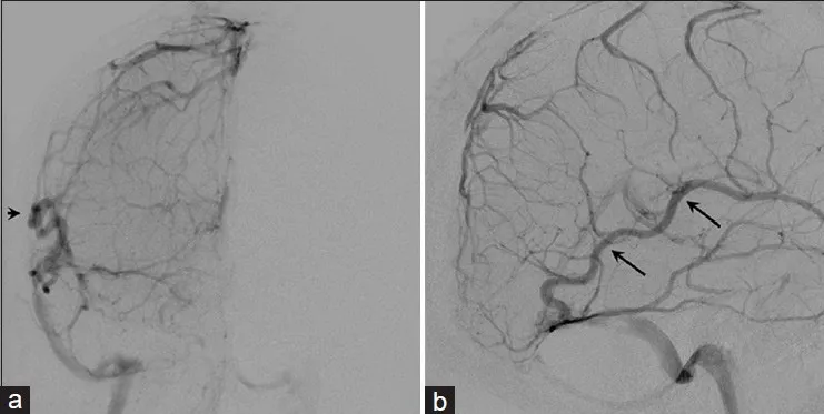 图3.右侧颈内动脉注射静脉期脑血管造影前后位（a）与侧位（b）观。皮质静脉经扩张的Labbe静脉引流（黑色箭头）