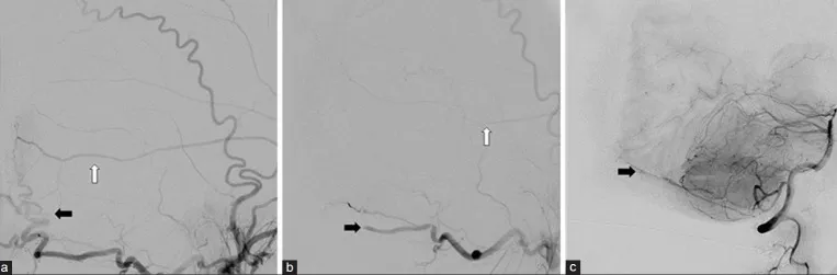 图4.左侧颈外动脉注射栓塞前（a）与栓塞后（b）图像。主要供血动脉包括枕动脉（黑色箭头）和脑膜中动脉（白色箭头）分支，已成功栓塞。右侧颈外动脉的类似分支亦进行了栓塞（未显示）。（c）右侧椎动脉注射显示小脑后下动脉发出的脑膜后动脉分支参与<a href='/naomoliu/' target='_blank'><u>脑膜瘤</u></a>供血。此分支未行栓塞