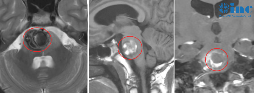 海绵状血管瘤。病灶正好就在脑干