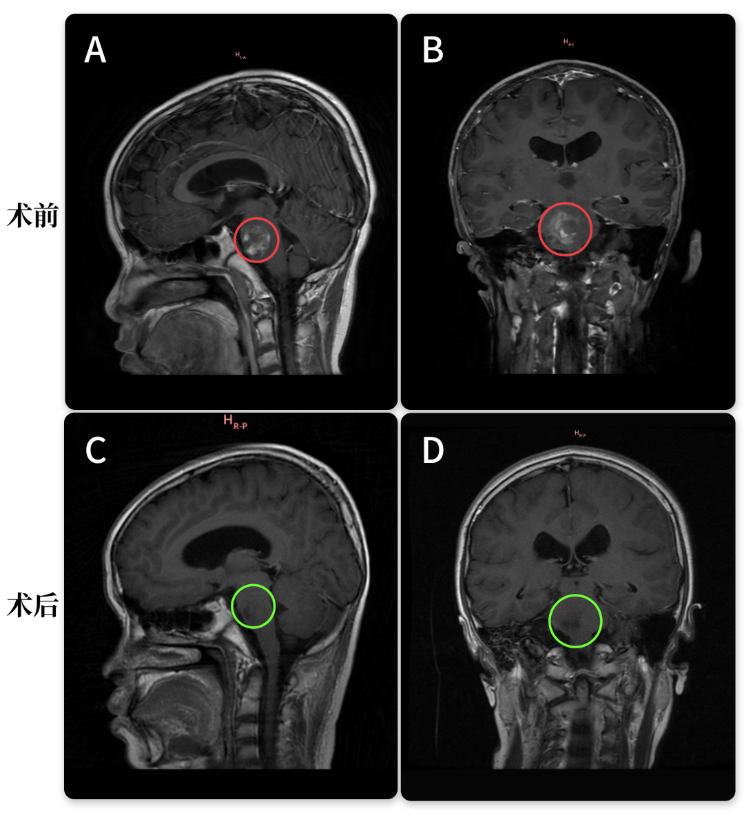 术后比我原来想象的要好