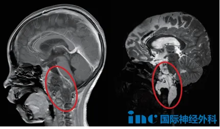 病理证实为脊索瘤