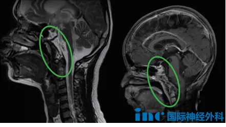 术后影像:2023年8 月患儿进行手术,术后 MRI 显示肿瘤切除率超过 95%,术后病理为颅底脊索瘤。本次核磁检查显示质子治疗效果显著。