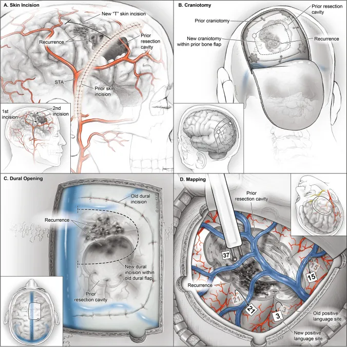 针对胶质瘤复发的技术考量。a. 再次开颅手术的皮肤切口可能无法完全覆盖肿瘤复发区域。若需扩大暴露范围，可采用垂直切口（即“T”形切口）延伸原切口。b. 若原骨瓣未与周围颅骨愈合，可将其完整取下并抬起；但若已愈合，则可在原骨瓣范围内重新开骨窗，以暴露复发灶。c. 皮质常在原缝合线下方与硬脑膜粘连最紧密，新硬脑膜瓣可在原硬脑膜开口内制作。必要时可跨越原缝合线一侧，以获得足够的皮质暴露。d. 胶质瘤复发的术中功能区定位需根据肿瘤位置个体化规划，可联合应用皮质及皮质下定位技术以保障安全切除。由于邻近皮质区域具有功能代偿能力，首次手术中定位阳性的区域在再次手术时可能不再显阳性。