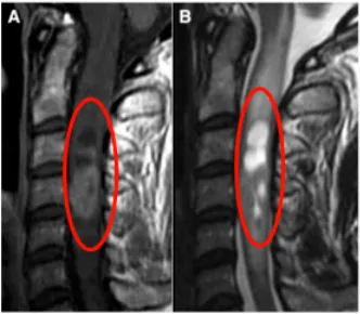 被诊断为脊髓髓内室管膜瘤，就连脑干延髓也出现了广泛水肿
