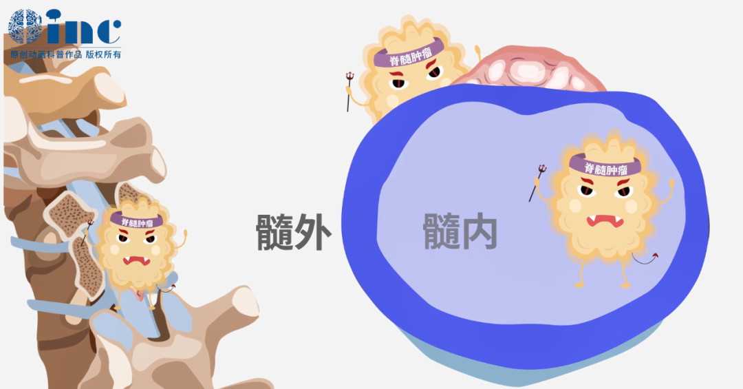 要么有可能治愈，要么可能面临终身瘫痪等严重后果。