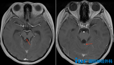 双侧脑室室管膜下可见数个小结节,医生怀疑为肿瘤复发或转移。