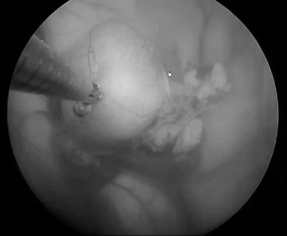 脑中的“水泡”