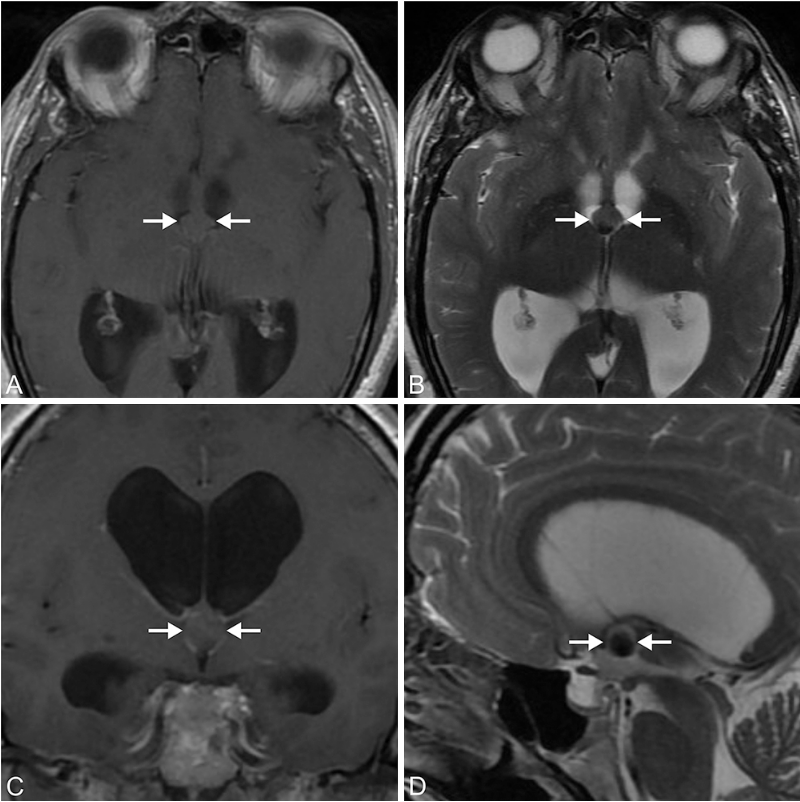 “脑子有泡”不是玩笑！一个“小孔”如何从第三脑室取出致命囊肿？