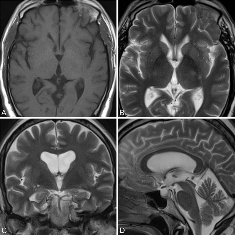 术后3年复查MRI（T1加权轴位A，T2加权轴位B、冠状位C、矢状位D）显示囊肿全切，无残留与复发征象，脑室系统形态恢复良好。