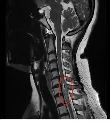 从“风湿”到脊髓肿瘤真相：当医生说“可能瘫痪”，我如何为自己做出了不同的选择？
