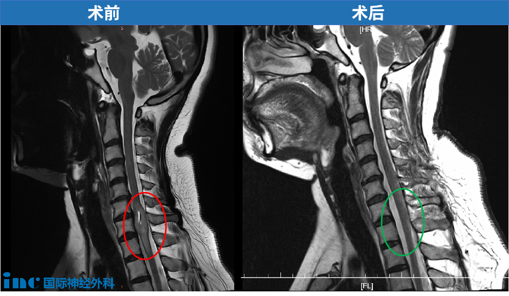 终于和那个肿瘤剥离了