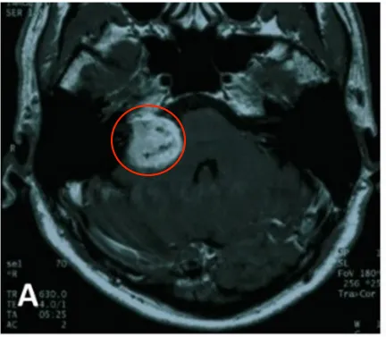 A.2004年4月最初等 MR图像，显示右侧桥小脑角（CPA）区肿瘤不均匀强化。