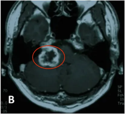  B. 2005年8月，第一次手术后、伽玛刀治疗前的MR图像。