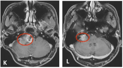  K-L. 2014年4月术前MR图像；M-N. 术后2个月随访图像