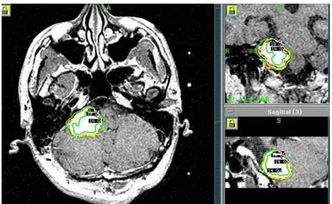 伽玛刀放射外科治疗计划