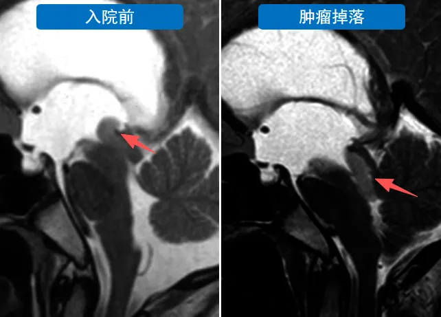 就在几分钟前,这个带蒂的肿瘤太“贪玩”,竟直直地“溜”进了导水管,这下,中脑导水管被完全堵塞,里里也几乎在瞬间昏迷。