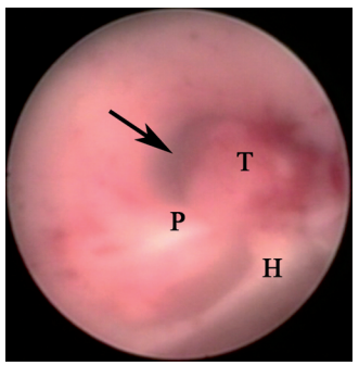内镜下见肿瘤(T)阻塞导水管入口(箭头所示),后连合(P)与缰连合(H)清晰可见。