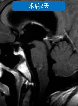 肿瘤全切,里里没有出现任何神经功能缺损,几天后顺利出院。