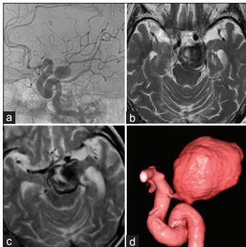 （a）确诊后 4 个月的血管造影显示，动脉瘤直径为 12mm，起源于后交通动脉。  （b）确诊后 2 年 3 个月的磁共振成像（MRI）显示，动脉瘤伴血栓形成，直径增大至 30mm，且压迫脑干。  （c）、（d）（确诊后）再经 6 个月，磁共振成像（c）及三维计算机断层扫描血管造影（3D-CTA，d）显示，病灶进一步扩大，直径达 35mm；动脉瘤从后交通动脉向上方扩张，右侧大脑后动脉未显影。