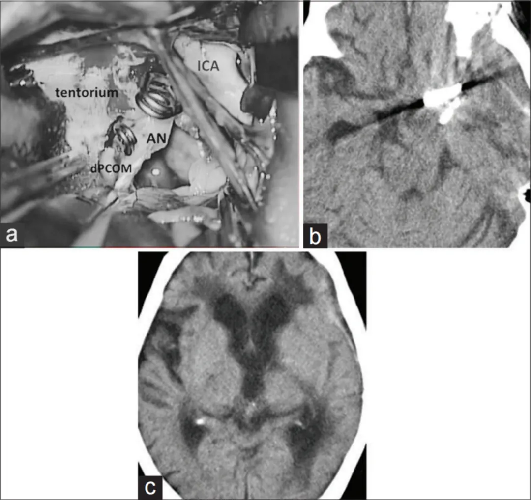 （a）经左侧经外侧裂入路的手术视野：动脉瘤已完成夹闭，瘤顶切开后实施了完整血栓切除术，未发现动脉瘤周围的滋养血管  ICA—— 颈内动脉（Internal carotid artery）；  AN—— 动脉瘤（Aneurysm）；  dPCOM—— 后交通动脉远端（Distal part of posterior communicating artery））。  （b）、（c）术后计算机断层扫描（CT）显示，脑干受压解除，且无缺血性病灶。
