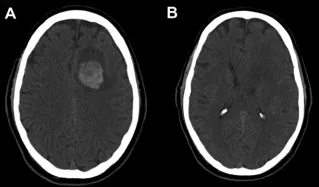 其左侧额上回区域发现一个与硬脑膜相连的类圆形病灶，内部已见出血迹象