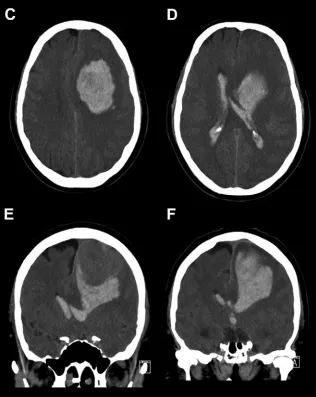 原病灶周围爆发大量脑实质内及脑室内出血