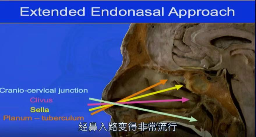 INC福洛里希教授演讲截图：经鼻内镜示意图