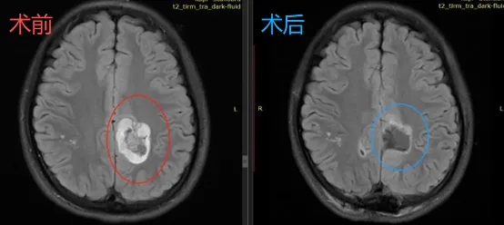 术后头颅MR(蓝色区域)显示:术前占位(红色区域)完整切除