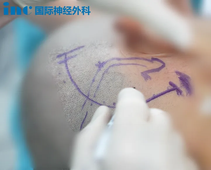 刘先生术中手术入路